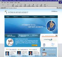 Anterior Hip Replacement